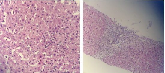 哈医大四院感染科反复肝功异常需警惕自身免疫性肝病
