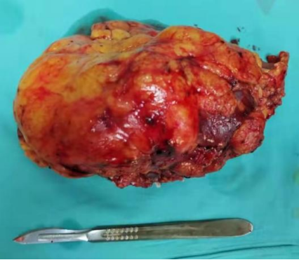 哈医大一院泌外专家应用达芬奇机机器人辅助腹腔镜彻底根治肾癌伴肾