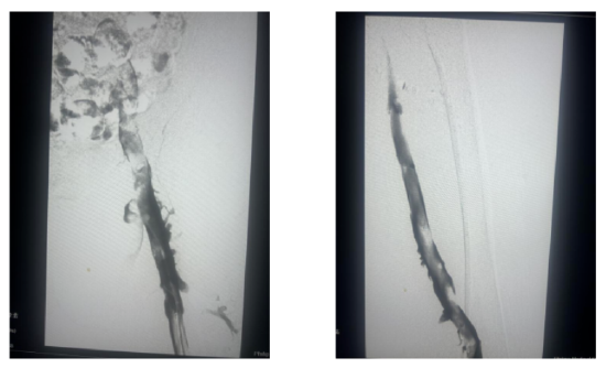 图左:造影显示左髂静脉大量血栓,显影不良  图右:抽吸后左髂静脉显影