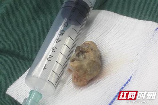 长沙52岁男子口腔恶臭遭家人嫌弃原是体内长了这个