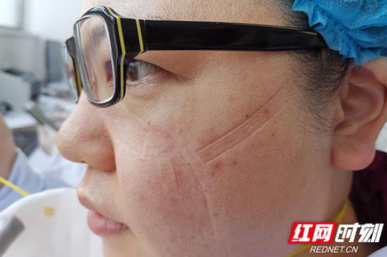 由于佩戴口罩时间长,熊佳丽的脸上留下深深的痕迹.