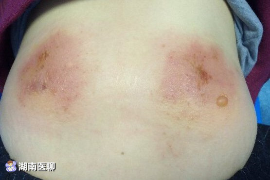 长沙一女子网购工具艾灸祛湿10天后皮肤烫成这样