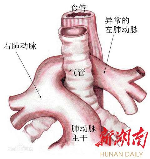 目前临床上对于长段气管狭窄矫治的手术被称为slide术,这个手术是重度