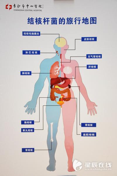 &nbsp;(结核杆菌可以感染人身体的多个器官和部位,它们会乘着空气&