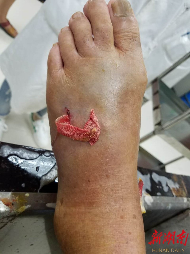 危险岳阳男子被蛇咬伤却对救命药过敏