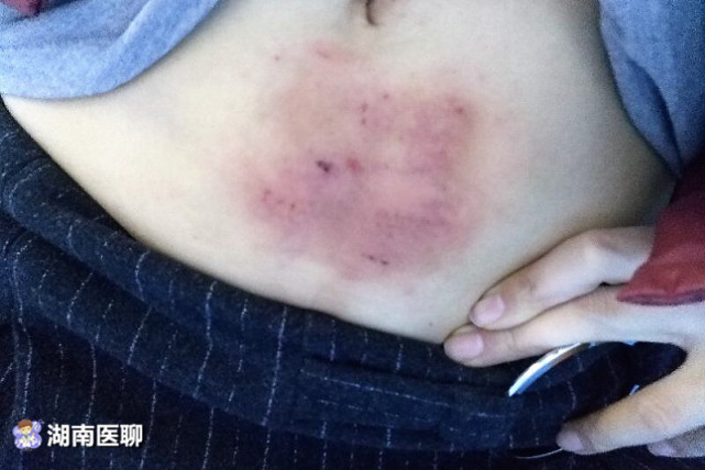 (吴女士皮肤被烫伤)