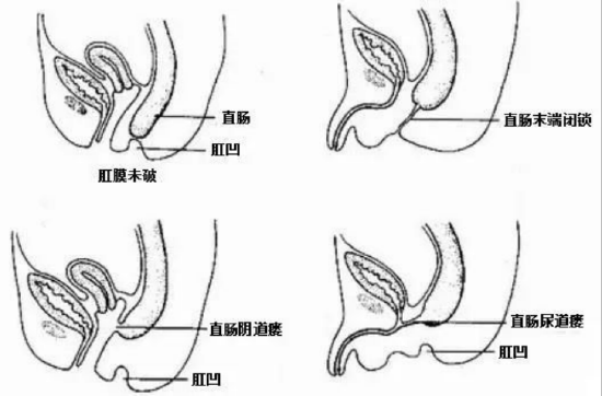 孩子肚子家长大小心出生6天女娃胀得像皮球竟是出生没有肛门