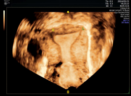 纵膈子宫三维彩超图片图片