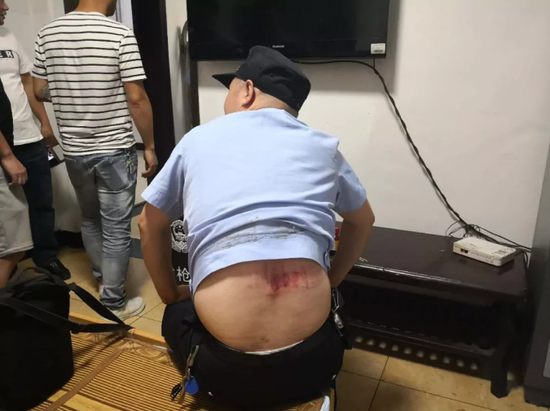 陈峰专心追捕嫌疑人不慎滑倒,造成后背靠腰部大面积划伤