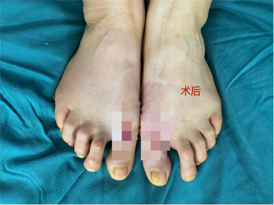 正"大脚骨" 让您"足"够完美