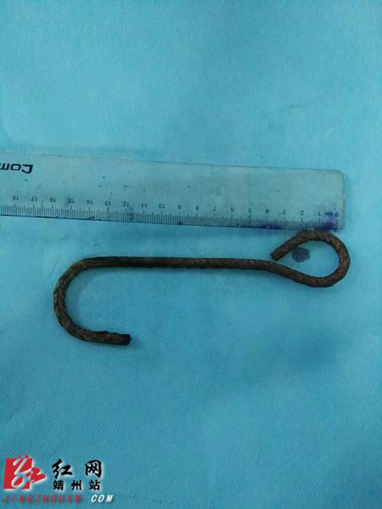 医生从阳阳小嘴里取出的大铁钩.颜丫丫摄