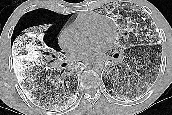 常德一男子肺部长满小结石因父母近亲结婚惹祸