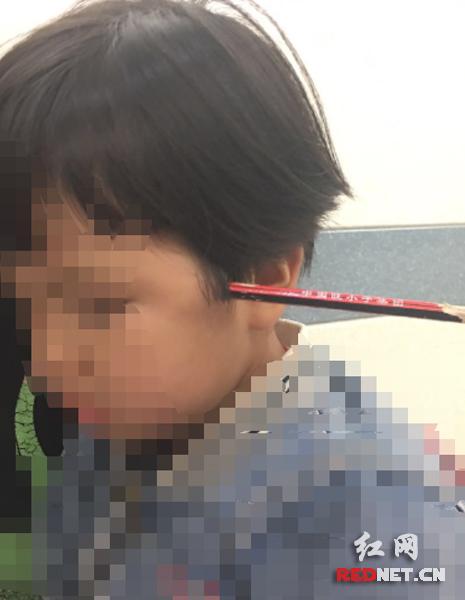 受伤后的童童.箭头指的分别是铅笔主体和进入眶内的笔尖.