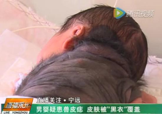 永州一男婴疑患兽皮痣皮肤被黑衣覆盖