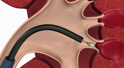 日间手术盛行国际医学界纤维无创取石技术成专宠
