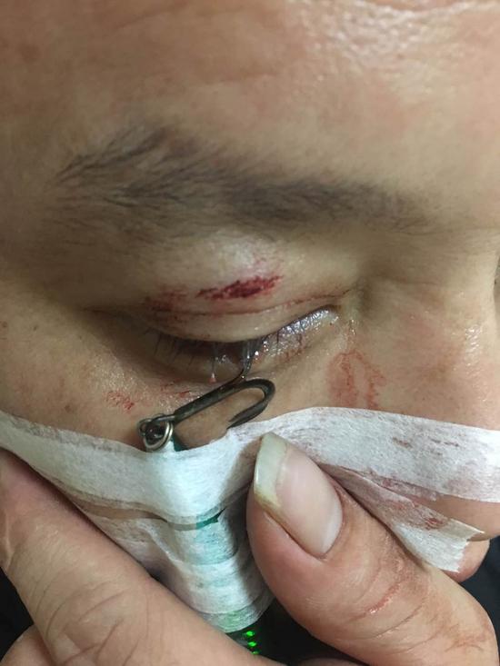 鱼钩有倒刺,手术难度不小
