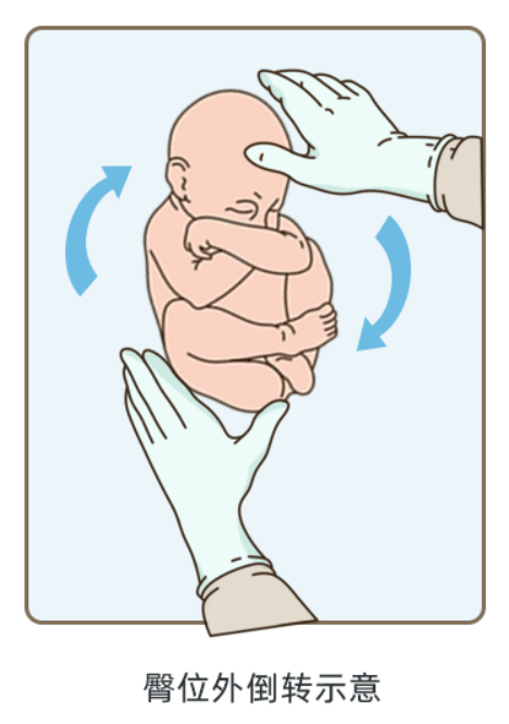 妇产科医生臀位外倒转术让剖宫变顺产