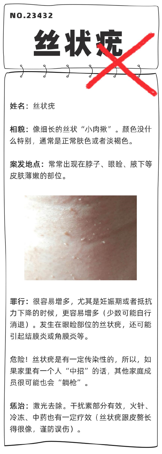 得了皮肤疣会传染吗