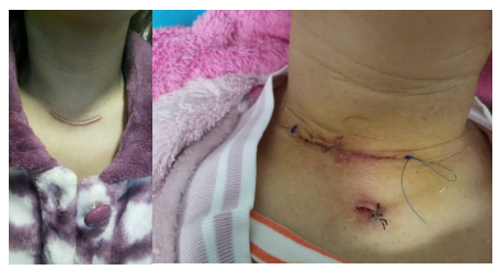 甲状腺肿瘤长在脖子上,却从嘴里切除还不留痕迹