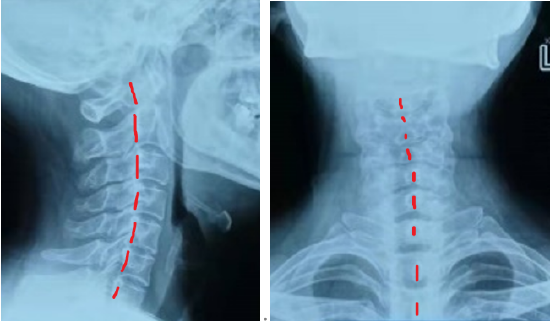 颈椎反弓侧弯图片