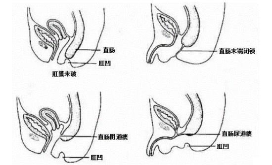 女婴出生无肛门2次手术惊险救回气球宝宝