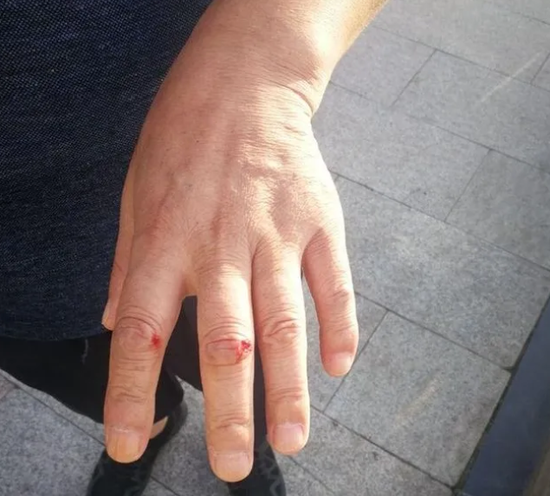 崔正浩手部多处擦伤