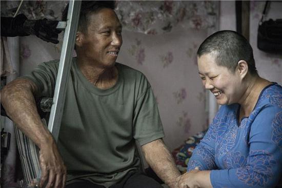 男子为救妻全身被烧伤妻子剃头陪他变丑