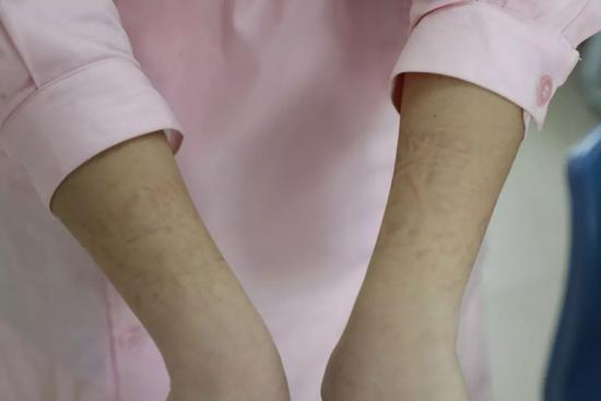 曝光共青城隔离区医护人员工作状态身上勒痕让人心疼