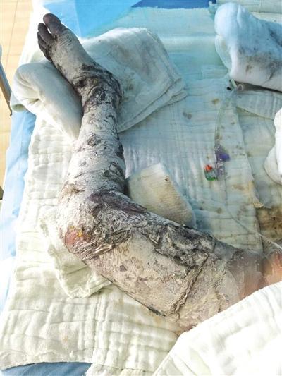 5岁幼童工厂内玩耍掉进滚烫热水沟 烫伤面积达30%