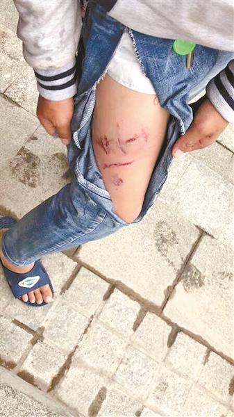 大狗没拴绳公园里连伤4人被咬女孩当晚惊醒大叫