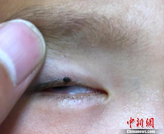 草地上撒欢打滚蜱虫钻进男孩睫毛间隙