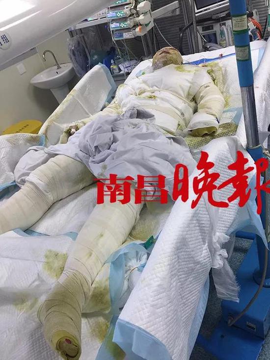 痛心南昌20岁情侣全身95烧伤女孩哭着要跳楼