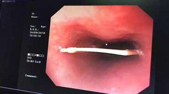 小龙的食道里有个3厘米的鸭骨头卡着.钱江晚报 图