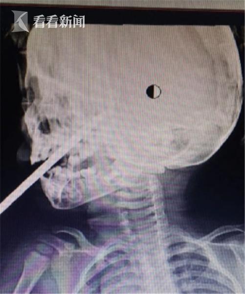 惊险2岁男童口腔插入50cm螺丝刀刺穿上颚