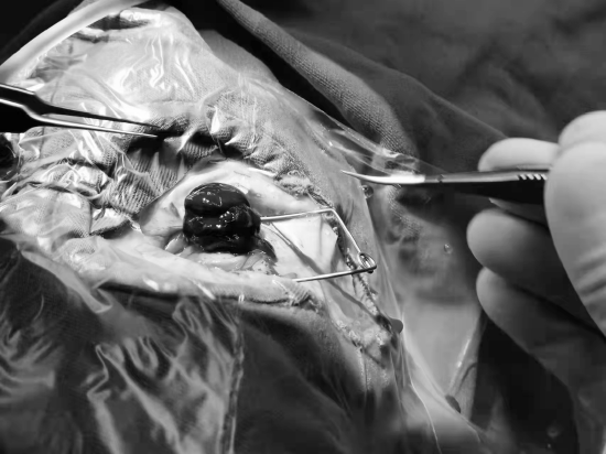 百岁老人突发眼球破裂多学科通力配合积极救治