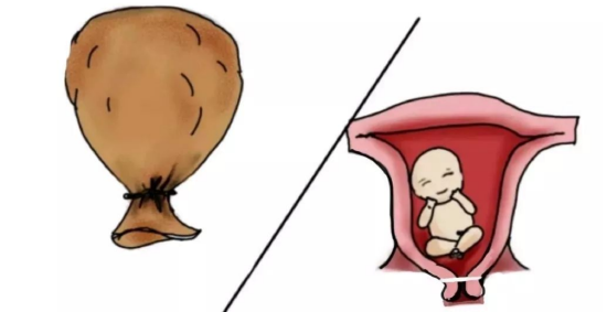 宫颈环扎术包括预防性宫颈环扎,治疗性宫颈环扎和紧急宫颈环扎.