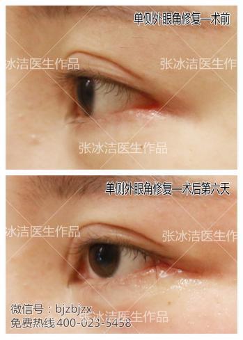 传统开外眼角手术容易出现的问题?