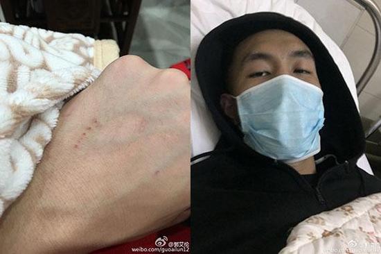 郭艾伦手上密密麻麻的针孔