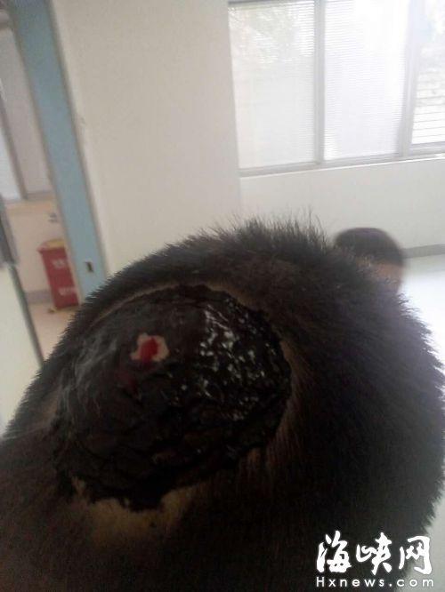 绿化树掉落蜂窝马蜂发狂追蜇 路人被扯下一块头皮