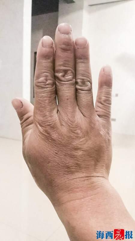 因为长期练功,张彬亮的双手十指粗壮,结实,手掌厚实,但也经常受伤.