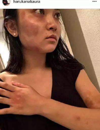 中浦悠花在社交媒体上发布的自己遭到家暴的图片。图自中浦悠花ins账号