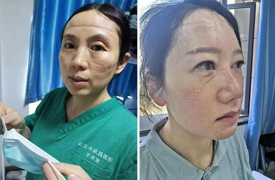 你的样子真美:他们穿着厚厚的防护服夜以继日,口罩磨破了脸颊,汗水湿透了衣背。摘下口罩的瞬间让人泪目,却又让人满血复活!(图片来源:空军军医大微信公众号、人民陆军微信公众号)