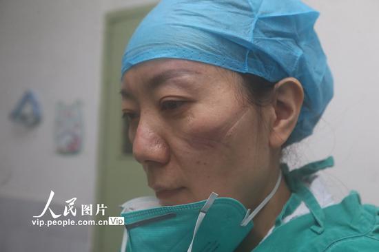 2020年2月3日，医生邓慧取下防护口罩，脸上已经被防护口罩深深勒出深痕。张忠苹/人民图片