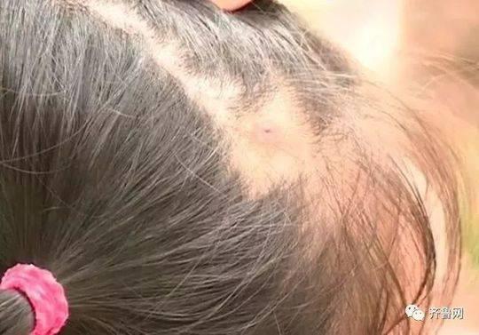 女童头皮上突现白"米粒" 医生拔出一半吓懵了|蜱虫|米粒|头皮_新浪