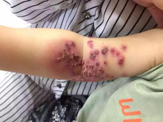 18个月宝宝被妈妈亲后 手臂长出疹子水疱红肿一片|水痘|单纯疱疹|口角