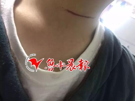 女子广场看夜景感觉脖子火辣辣 原来是碰了这东西