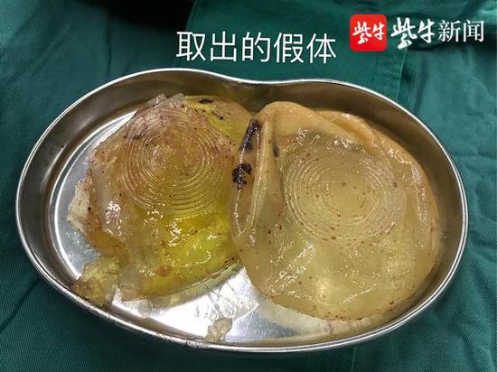 最担心的还是发生了:女子隆胸假体破裂形如“