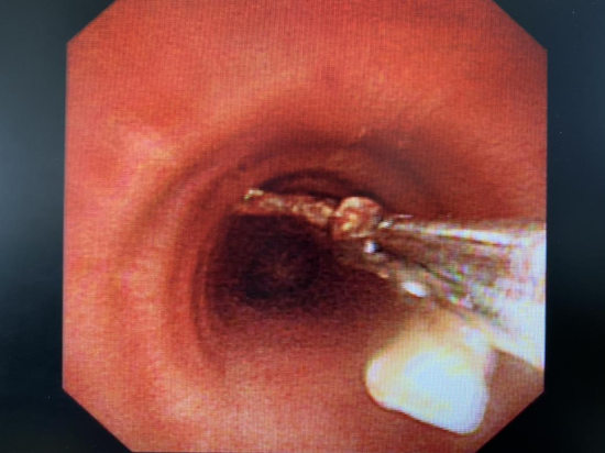 疫情期间咳成狗，她竟“咳”出了10年前的鸡骨头