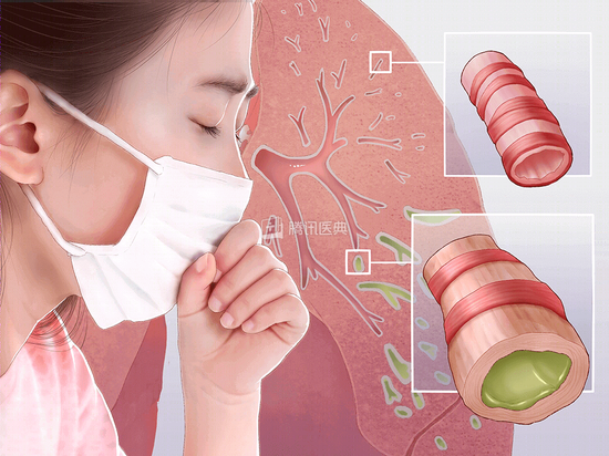 支气管扩张，来源：腾讯医典