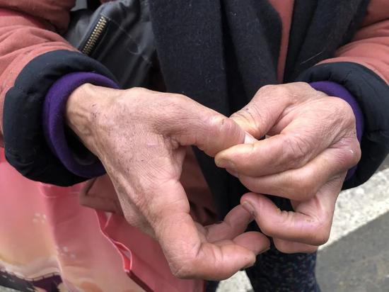 ▲文军红的手上布满狗咬的伤痕和干裂的伤口。骚作者不祥狠狠干记者 王翀鹏程 摄